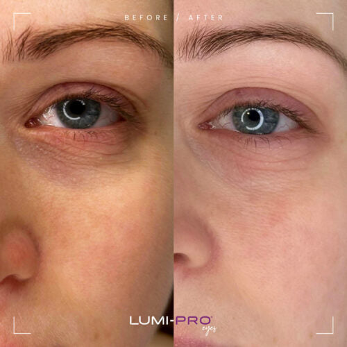 LUMI-PRO Eyes PN Skin Booster  -1x1ml per pack inc Polynucleotide (PN) 5 mg/ml
