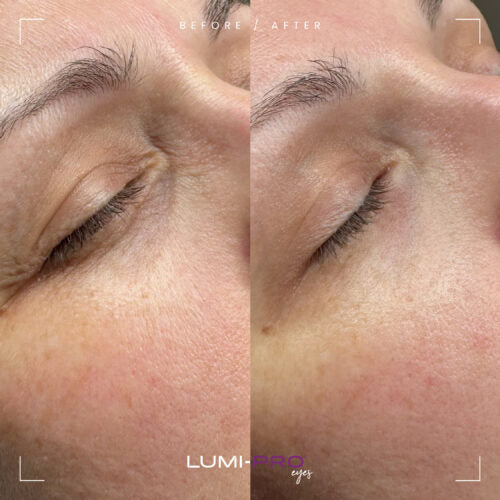 LUMI-PRO Eyes PN Skin Booster  -1x1ml per pack inc Polynucleotide (PN) 5 mg/ml