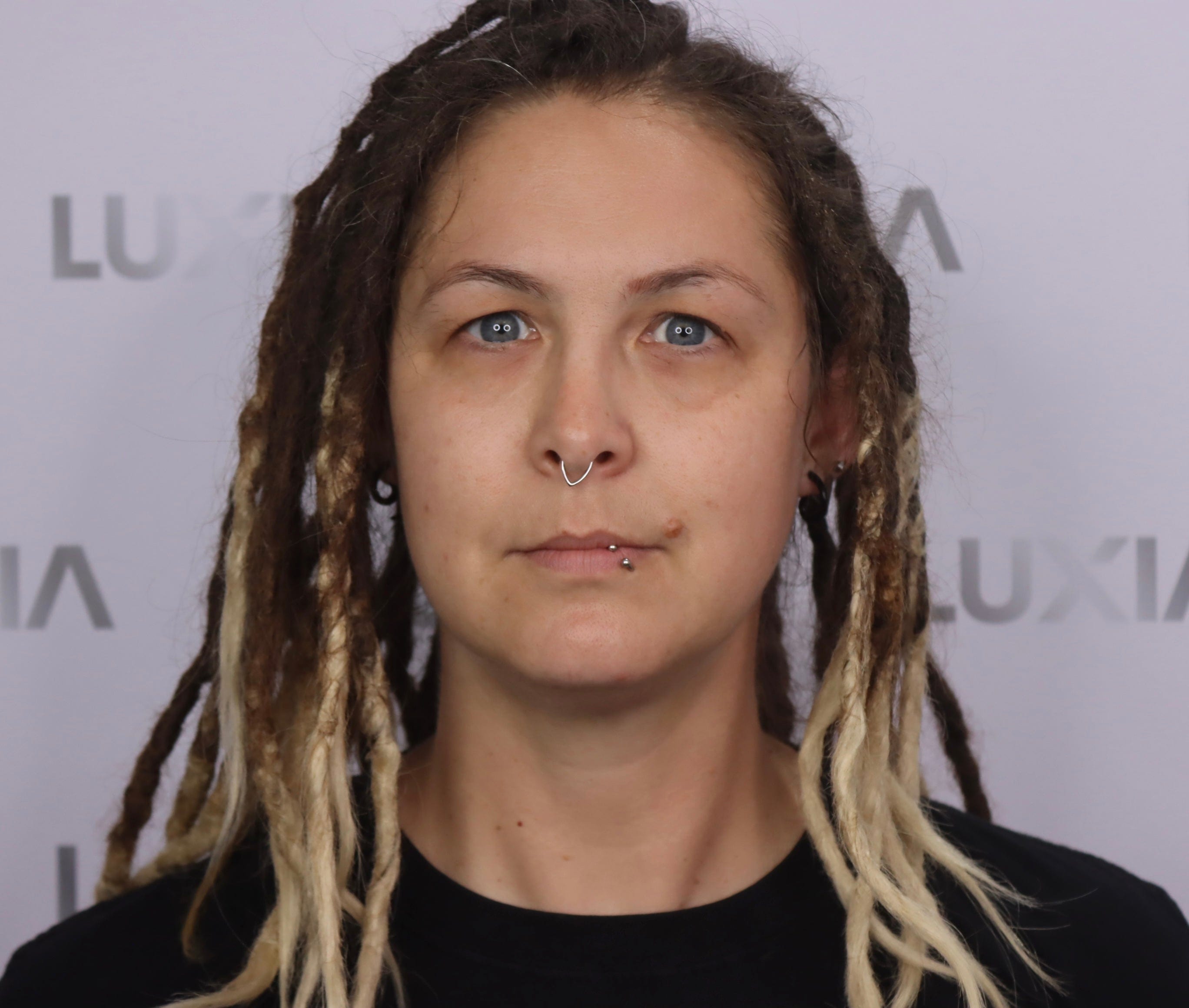 LUXIA Fat Dissolver 5 x 10ml image of woman after using fat dissolver on face