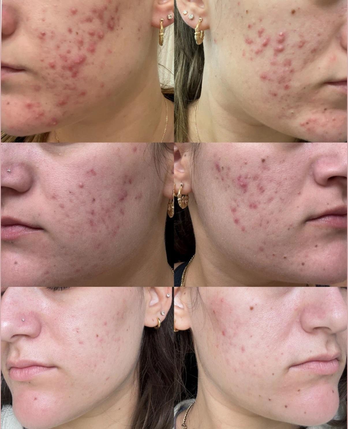 LUXIA Hyperpigmentation Skin Peel 5 x 10ml - before and after images of customers had treatment